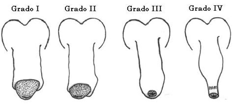 fimosis imagenes|La fimosis es la anomalía congénita mas frecuente del。